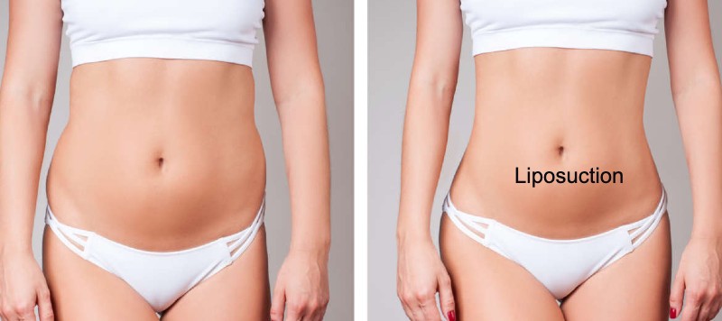 liposuction before and after