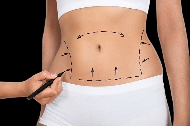 Tummy tuck